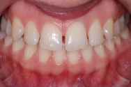 Before - Kettering Dental