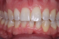 After - Kettering Dental