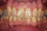 Before - Kettering Dental