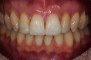 After - Kettering Dental