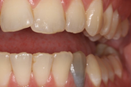 Before - Kettering Dental