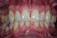 Before - Kettering Dental