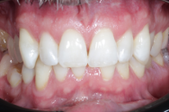 After - Kettering Dental