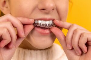 Girl wearing clear aligners.