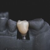 dental implant on a fake mouth