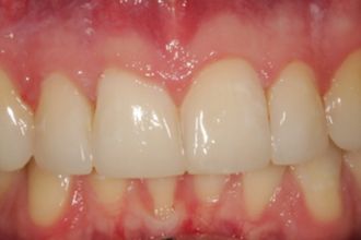 After - Kettering Dental
