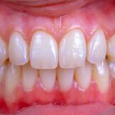 someone showing their teeth and has cavities on the left side of their teeth and silver filling